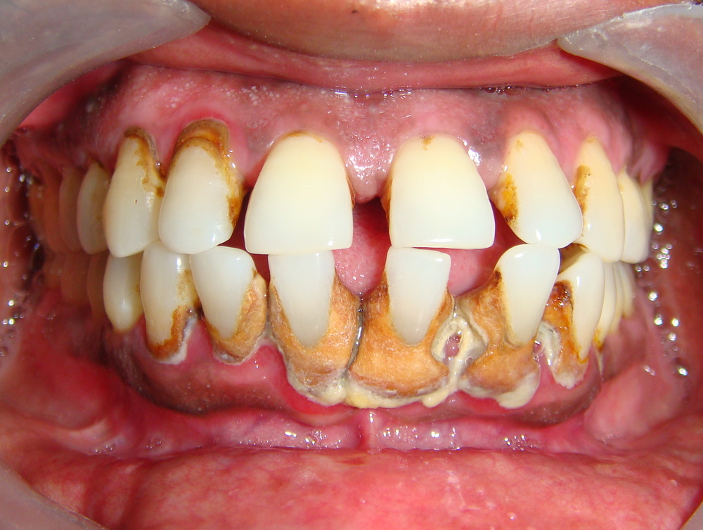 Build up plaques like bad teeth King Of The City by XV